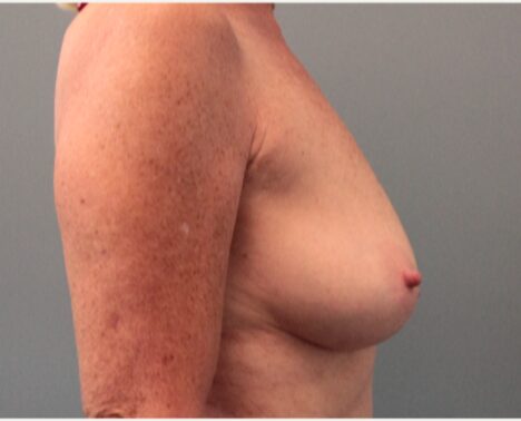 Before — 62 year old woman treated with Breast Lift