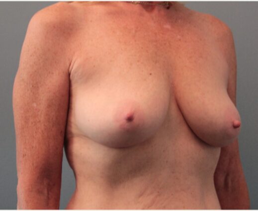 Before — 62 year old woman treated with Breast Lift with Implants