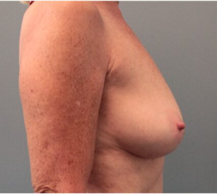 Before — 62 year old woman treated with Breast Lift with Implants