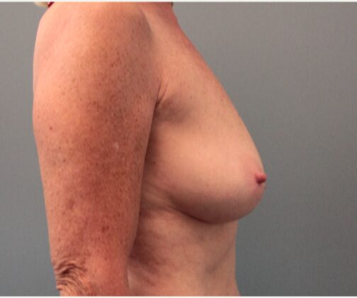 Before — 62 year old woman treated with Sientra Breast Implants