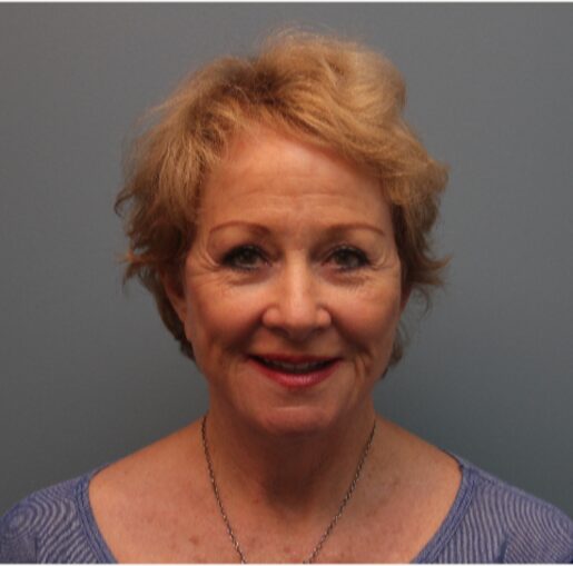 After — 79 year old woman treated with Facelift