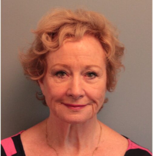 Before — 79 year old woman treated with Facelift