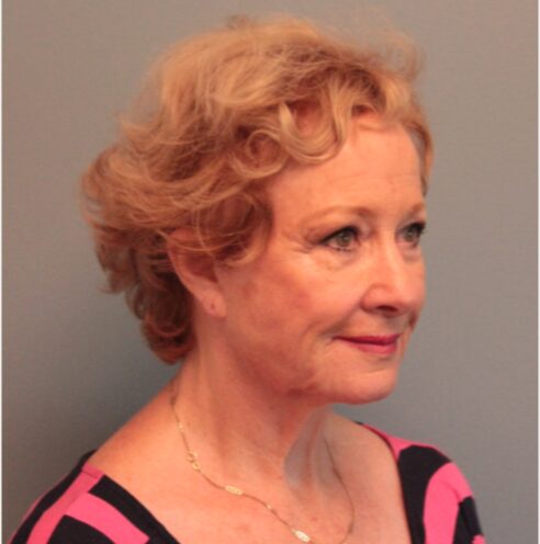 Before — 79 year old woman treated with Facelift