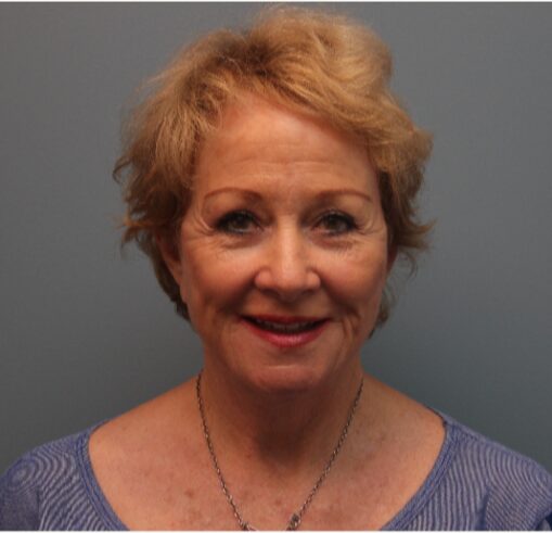 After — 79 year old woman treated with Lifestyle Lift