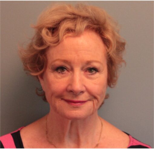 Before — 79 year old woman treated with Lifestyle Lift