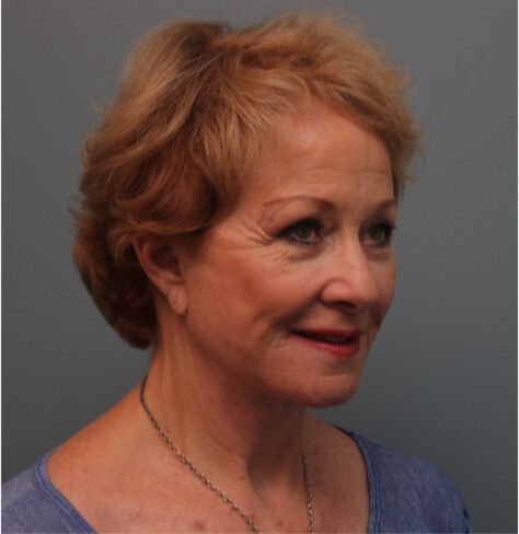 After — 79 year old woman treated with Lifestyle Lift