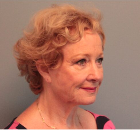 Before — 79 year old woman treated with Lifestyle Lift
