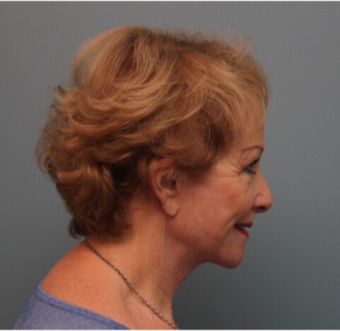 After — 79 year old woman treated with Lifestyle Lift