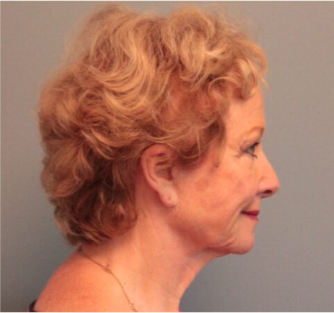 Before — 79 year old woman treated with Lifestyle Lift