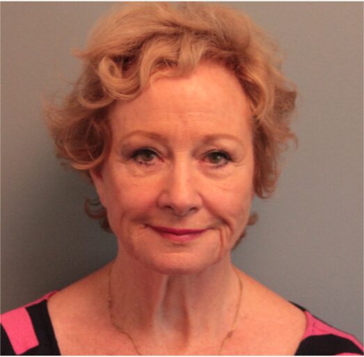 Before — 79 year old woman treated with MACS Facelift