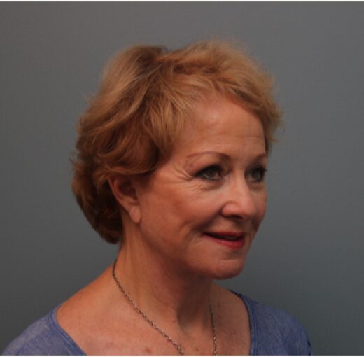 After — 79 year old woman treated with MACS Facelift