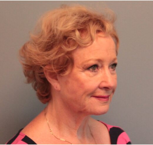 Before — 79 year old woman treated with MACS Facelift