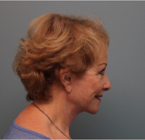 After — 79 year old woman treated with MACS Facelift