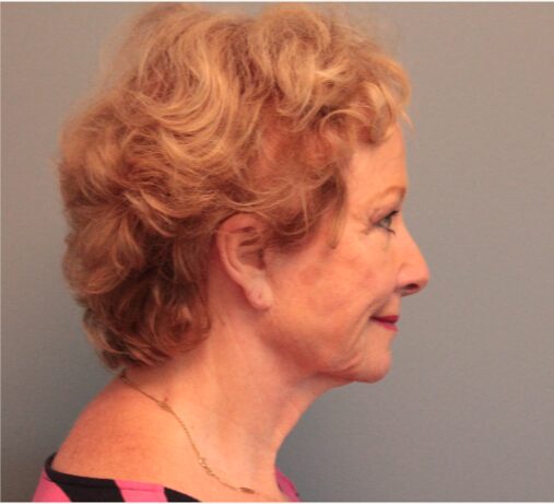 Before — 79 year old woman treated with MACS Facelift