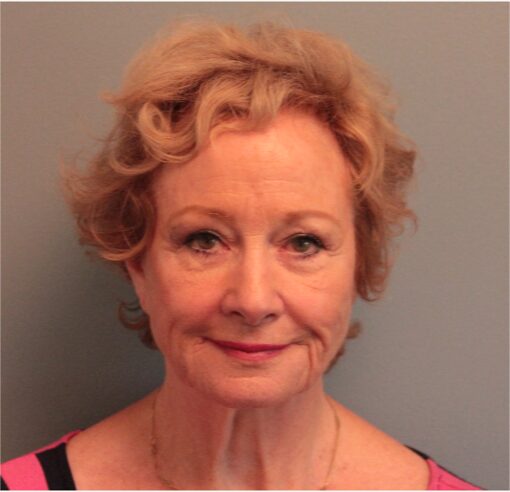 Before — 79 year old woman treated with SMAS Facelift