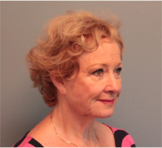 Before — 79 year old woman treated with Lower Face Lift