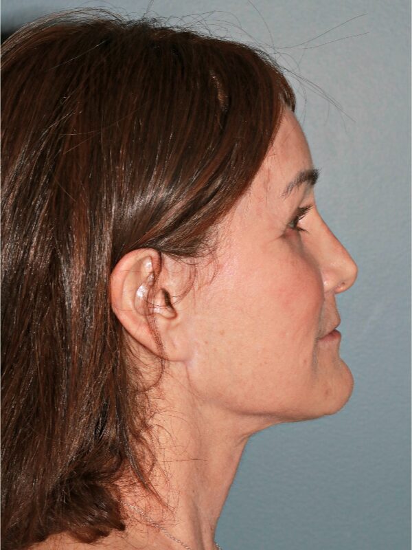 After — 54 year old woman treated with Deep Plane Facelift