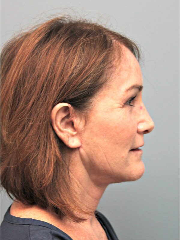 Before — 54 year old woman treated with Deep Plane Facelift