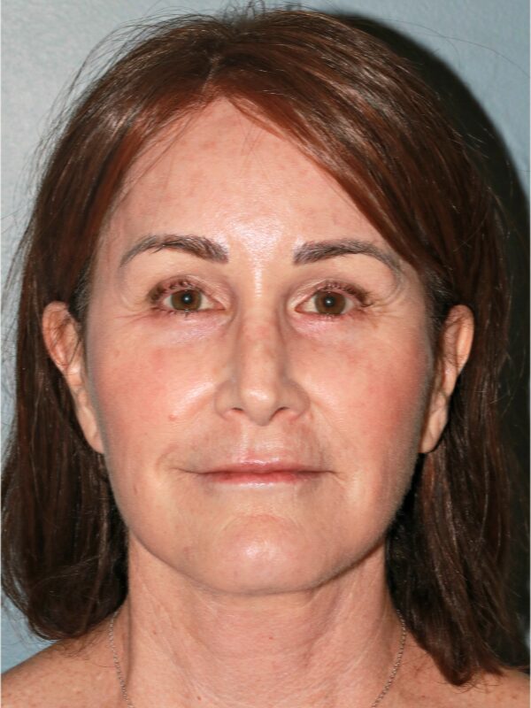 After — 54 year old woman treated with Lifestyle Lift