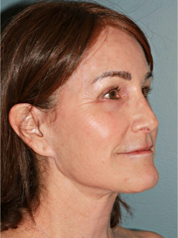 After — 54 year old woman treated with Lower Face Lift