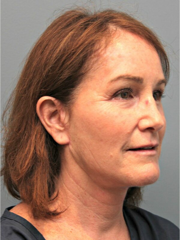 Before — 54 year old woman treated with Lower Face Lift