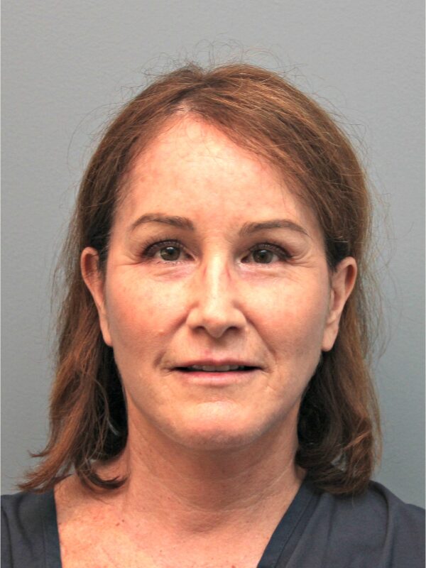 Before — 54 year old woman treated with MACS Facelift