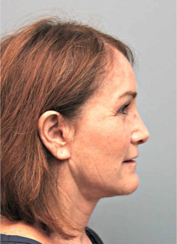 Before — 54 year old woman treated with MACS Facelift
