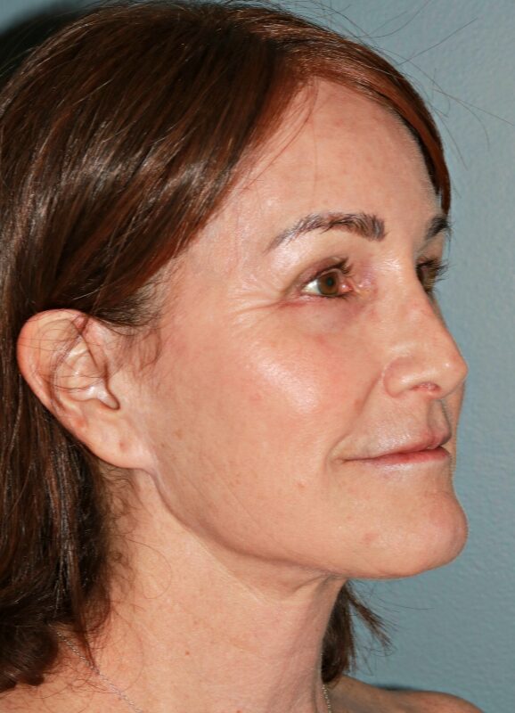 After — 54 year old woman treated with SMAS Facelift