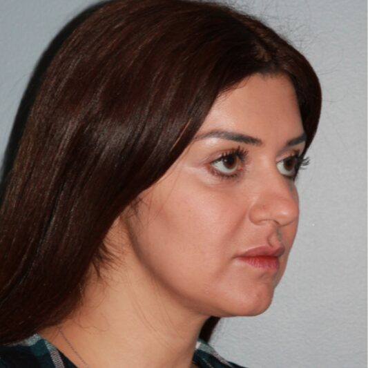 Before — 36 year old woman treated with Chin Implant