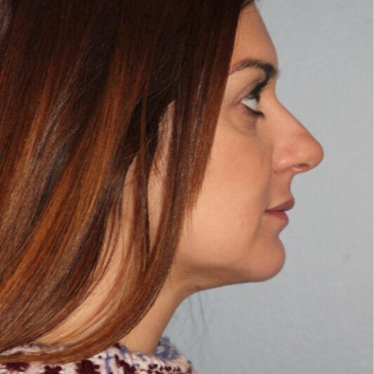 After — 36 year old woman treated with Chin Implant
