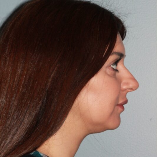 Before — 36 year old woman treated with Chin Implant