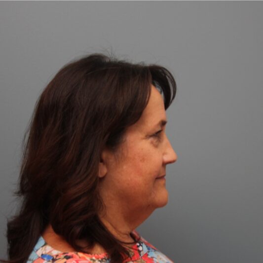 Before — 61 year old woman treated with LiteLift® Facelift