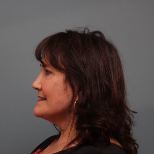 After — 61 year old woman treated with Lower Face Lift
