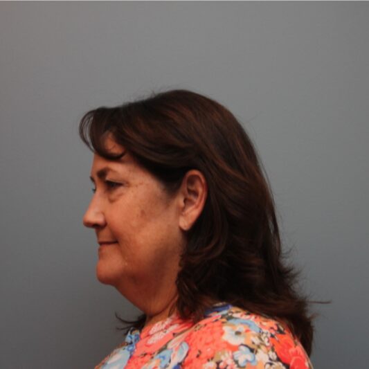 Before — 61 year old woman treated with Lower Face Lift