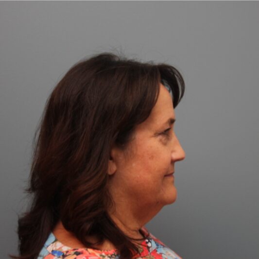 Before — 61 year old woman treated with MACS Facelift