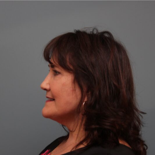 After — 614 year old woman treated with a type of Lifestyle Lift