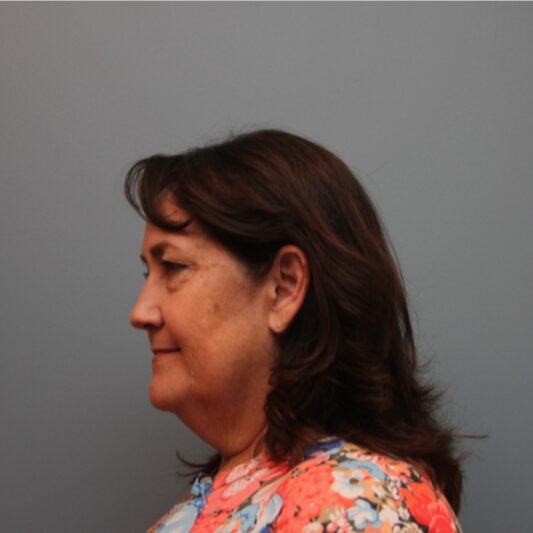 Before — 614 year old woman treated with a type of Lifestyle Lift