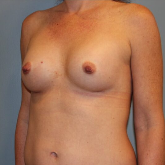 After — 39 year old woman treated with Breast Implants