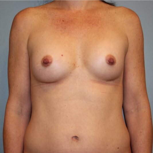 After — 39 year old woman treated with Ideal Implant