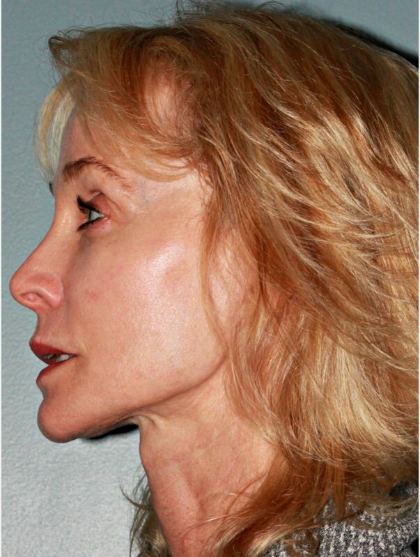 After — 53 year old woman treated with Facelift