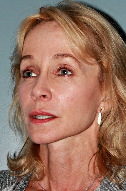 After — 53 year old woman treated with MACS Facelift