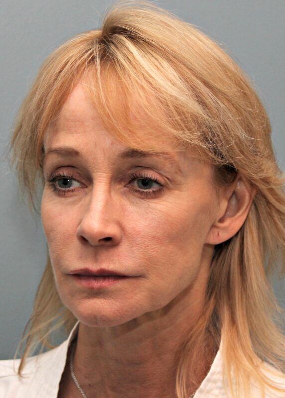 Before — 53 year old woman treated with MACS Facelift