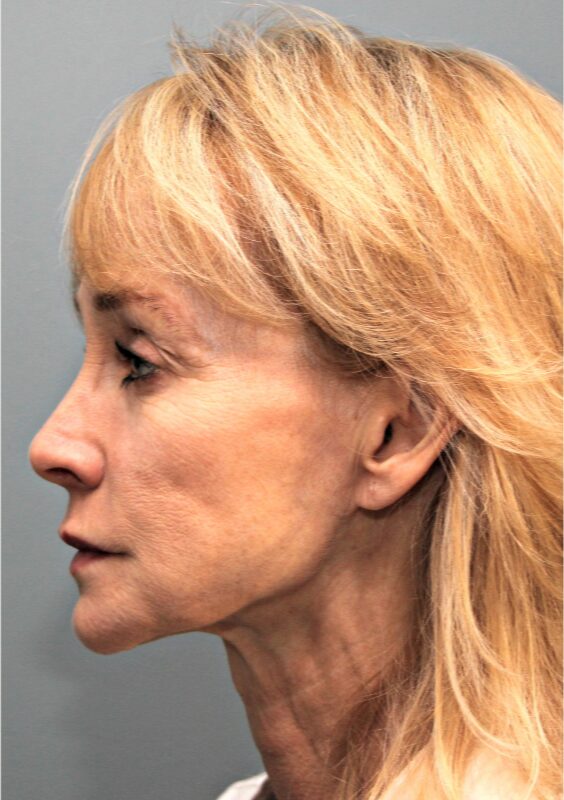 Before — 53 year old woman treated with MACS Facelift