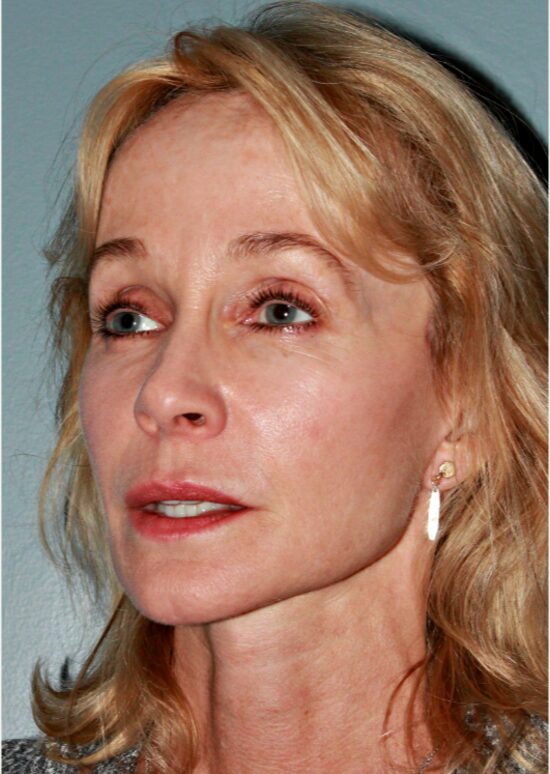 After — 53 year old woman treated with Lower Face Lift