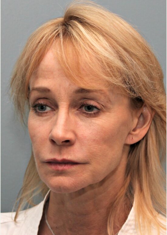 Before — 53 year old woman treated with Lower Face Lift