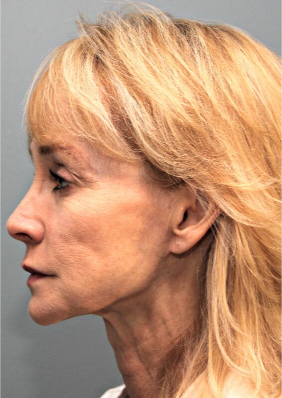 Before — 53 year old woman treated with Lower Face Lift