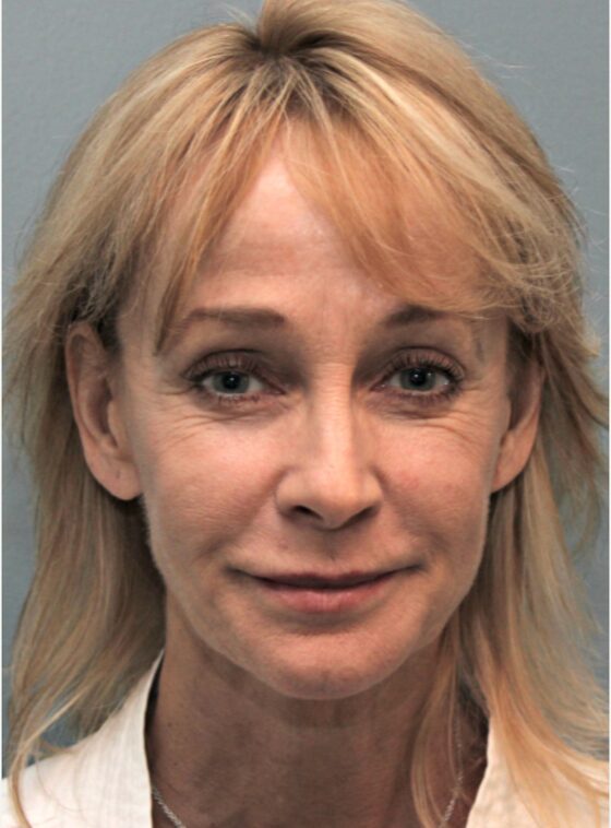 Before — 53 year old woman treated with SMAS Facelift