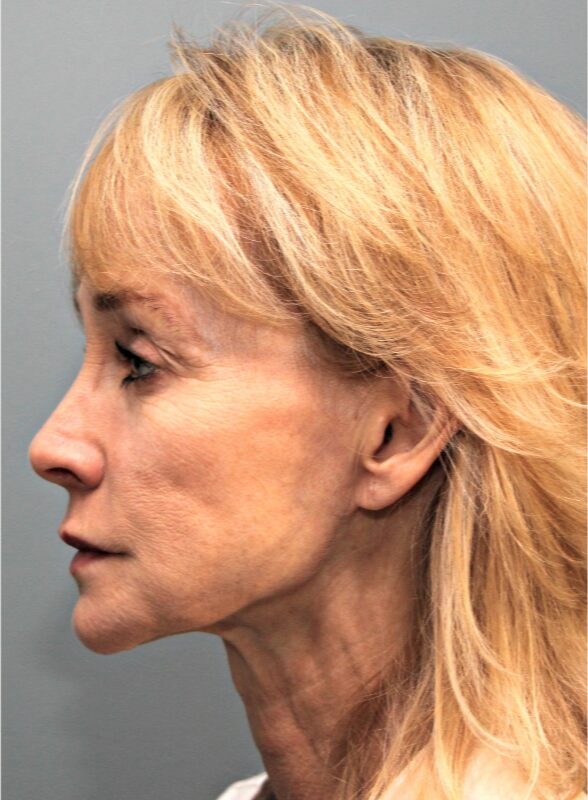 After — 53 year old man treated with SMAS Facelift
