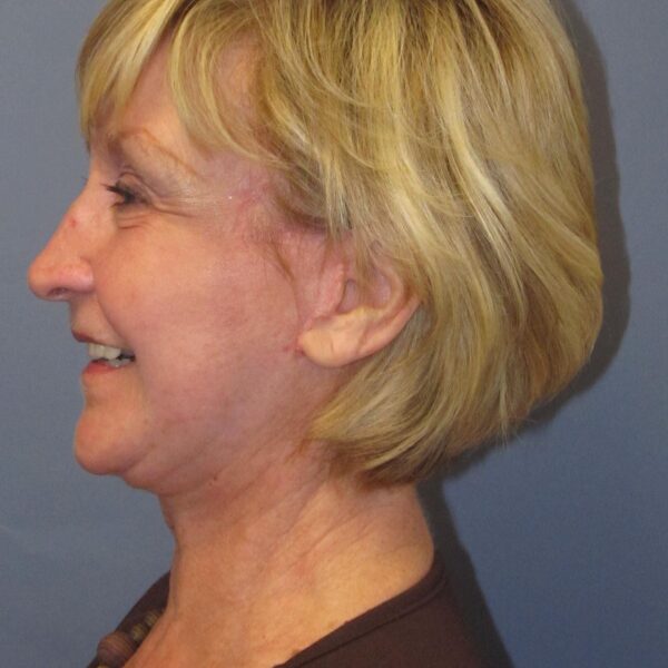 After — 72 year old woman treated with Facelift