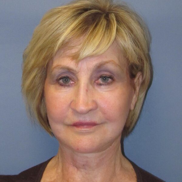 After — 72 year old woman treated with Lower Face Lift